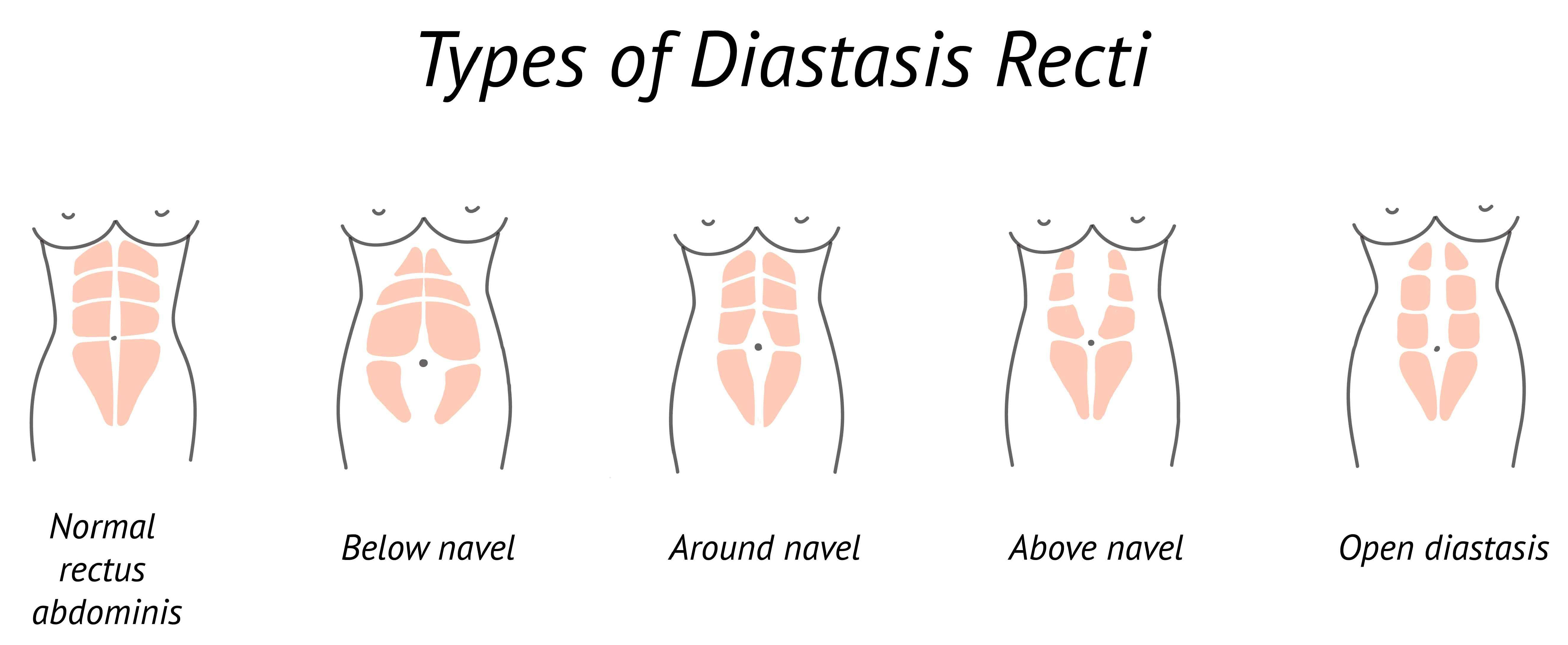 Graphic showing five types of Diastasis Recti